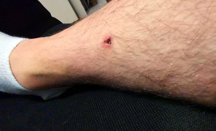 Blessure due au cadre de lit